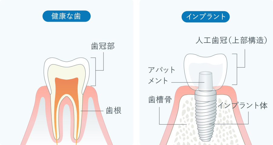 健康な歯とインプラントの比較